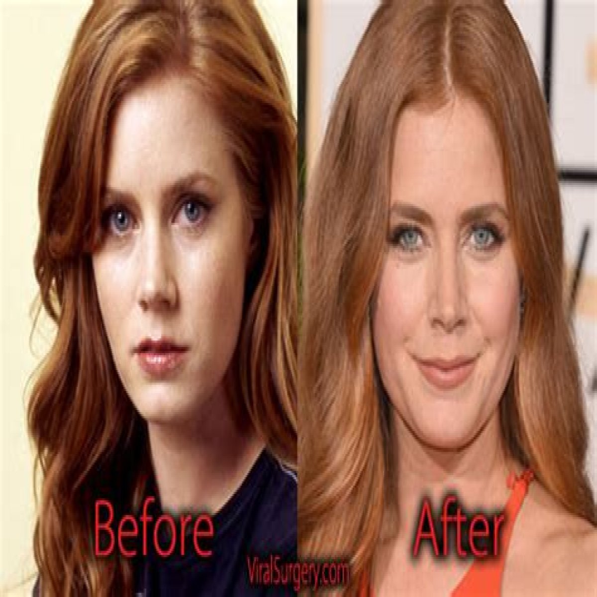 Amy Adams Plastic Surgery Before and After