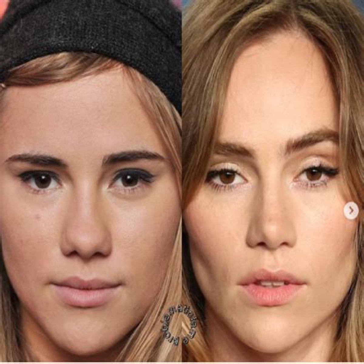 Did Suki Waterhouse Undergo Plastic Surgery? Before And After Pics – Boyfriend And Instagram