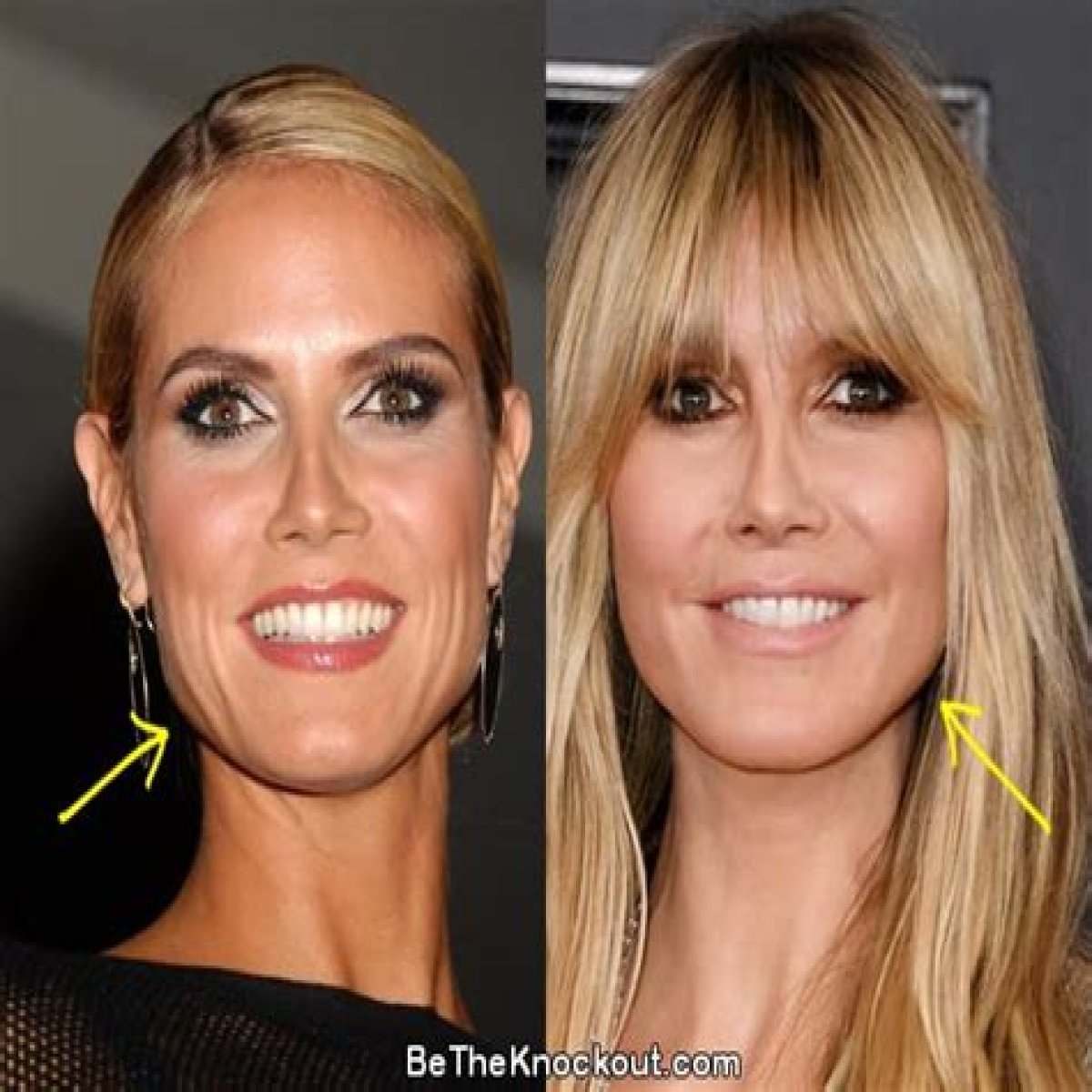 Heidi Klum: plastic surgery “doesn’t look pretty, especially on young girls”