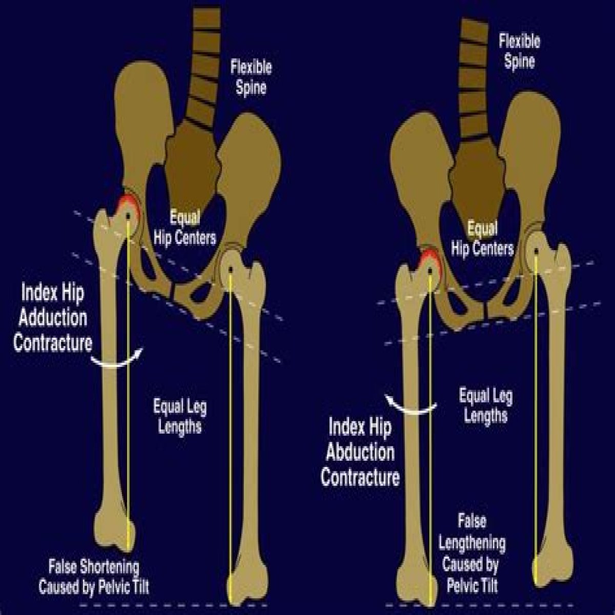 How Leg Positions Effect Height in Photos