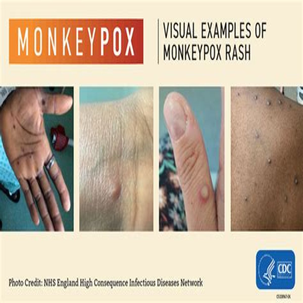 If You Get Monkeypox, Here's How to Take Care Of Your Skin and Minimize Scarring