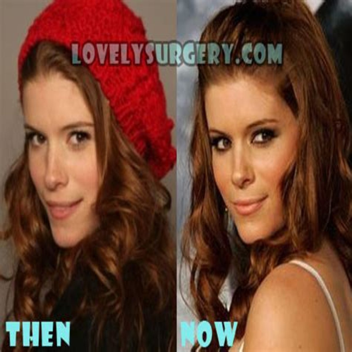 Kate Mara Plastic Surgery Before and After