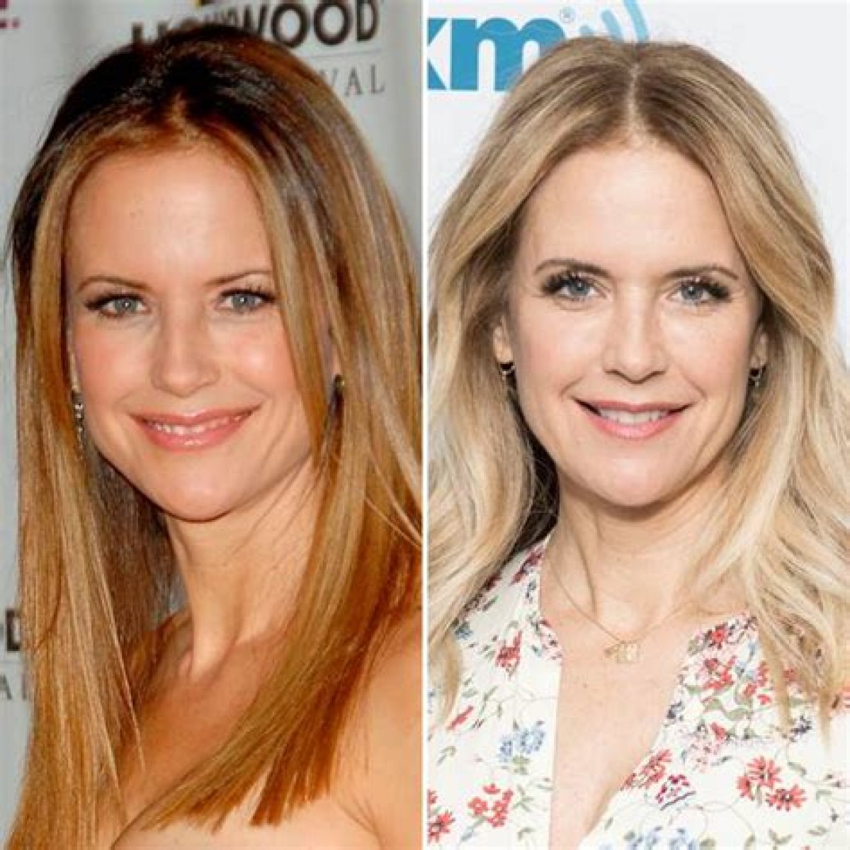 Kelly Preston Plastic Surgery Before and After