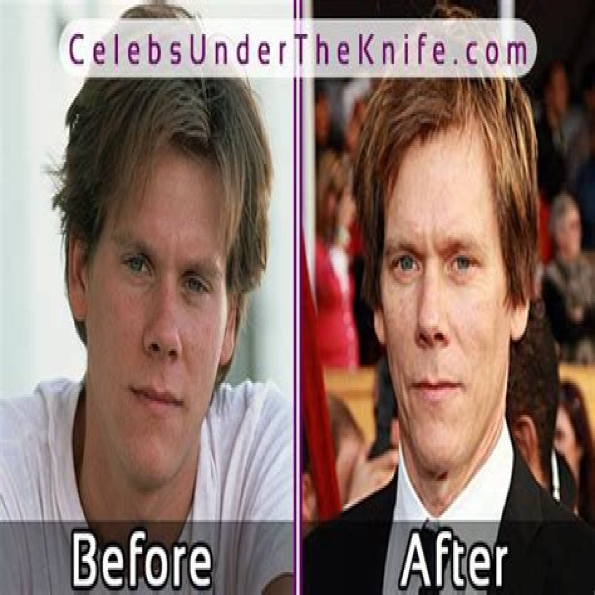 Kevin Bacon Plastic Surgery Before and After