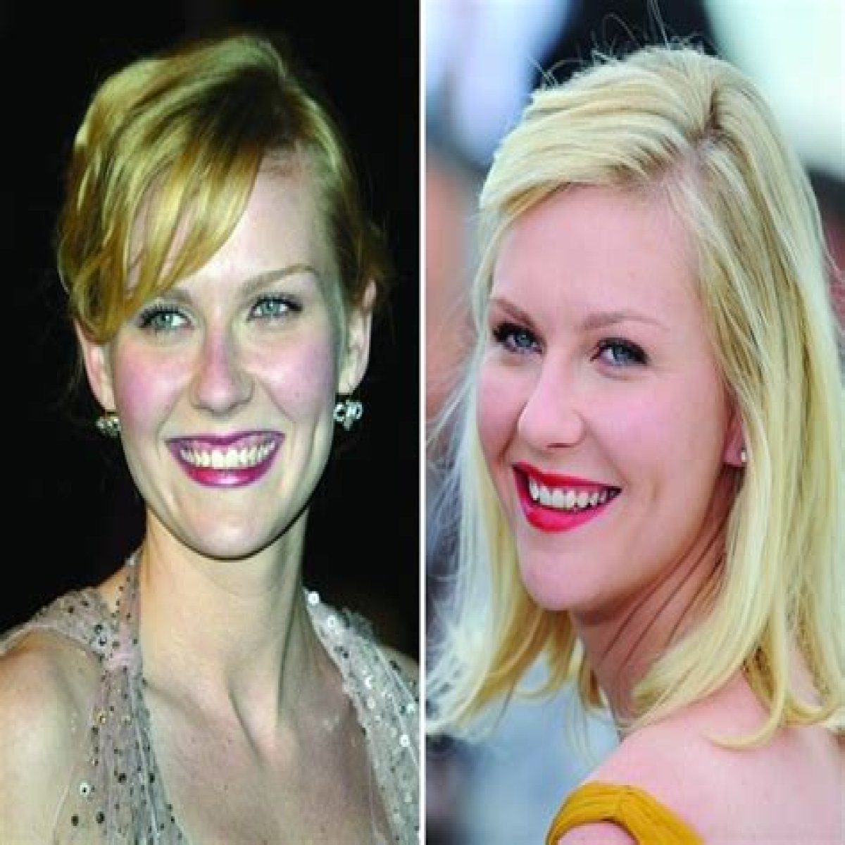 Kirsten Dunst Plastic Surgery Before and After