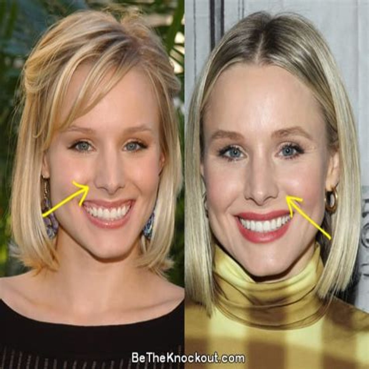 Kristen Bell Plastic Surgery Before and After