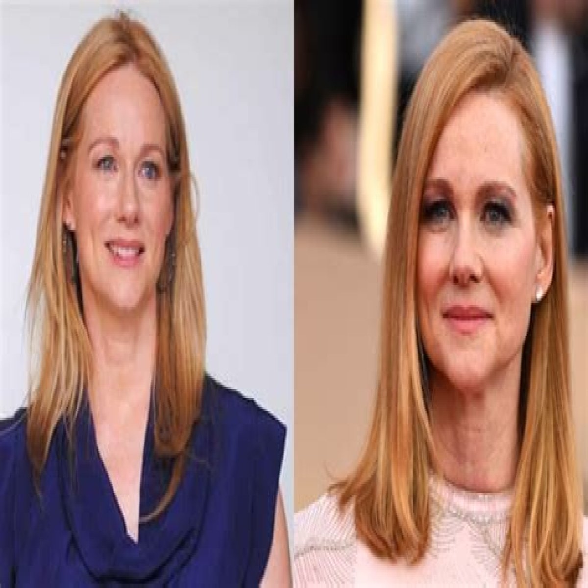 Laura Linney Plastic Surgery Before and After