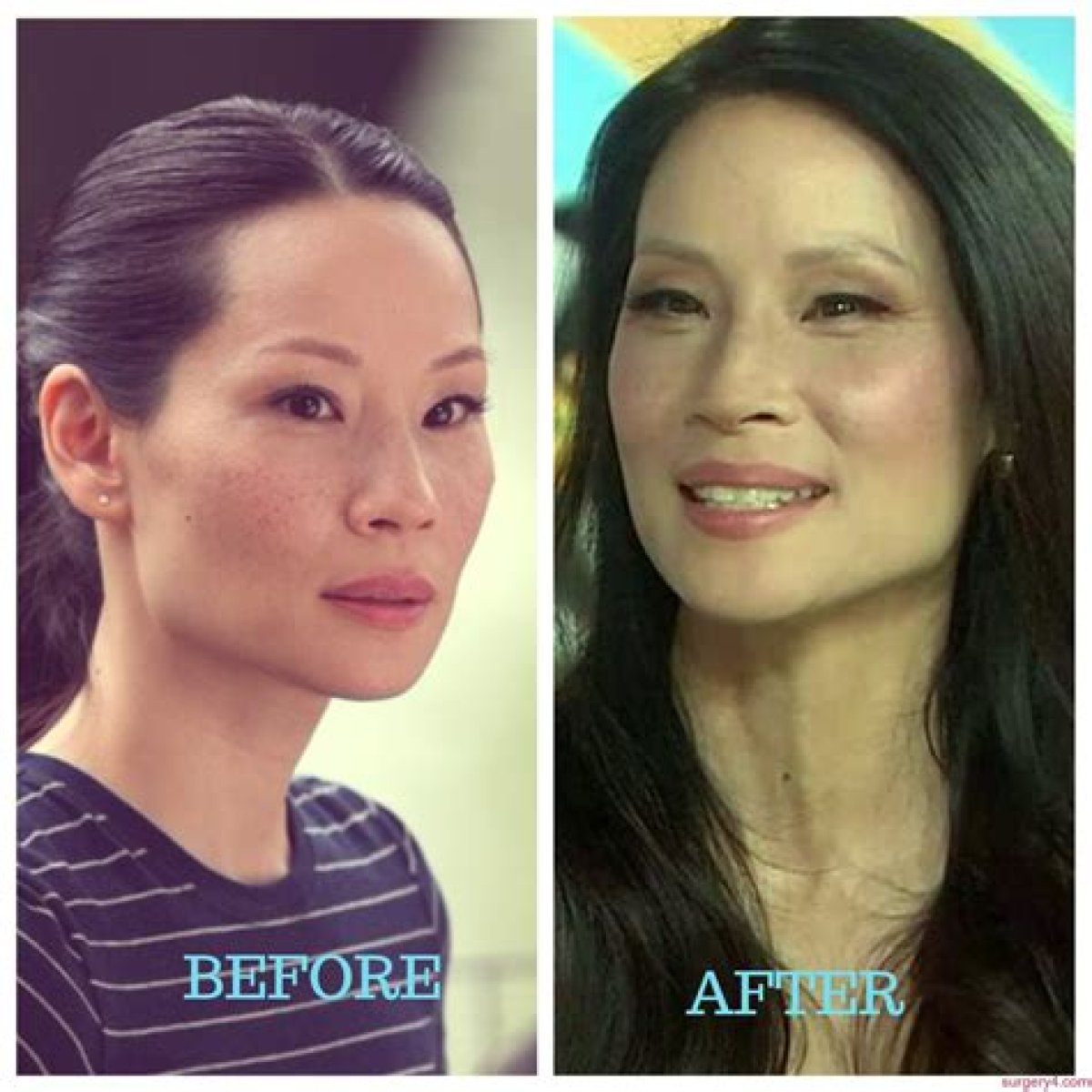 Lucy Liu Plastic Surgery Before and After