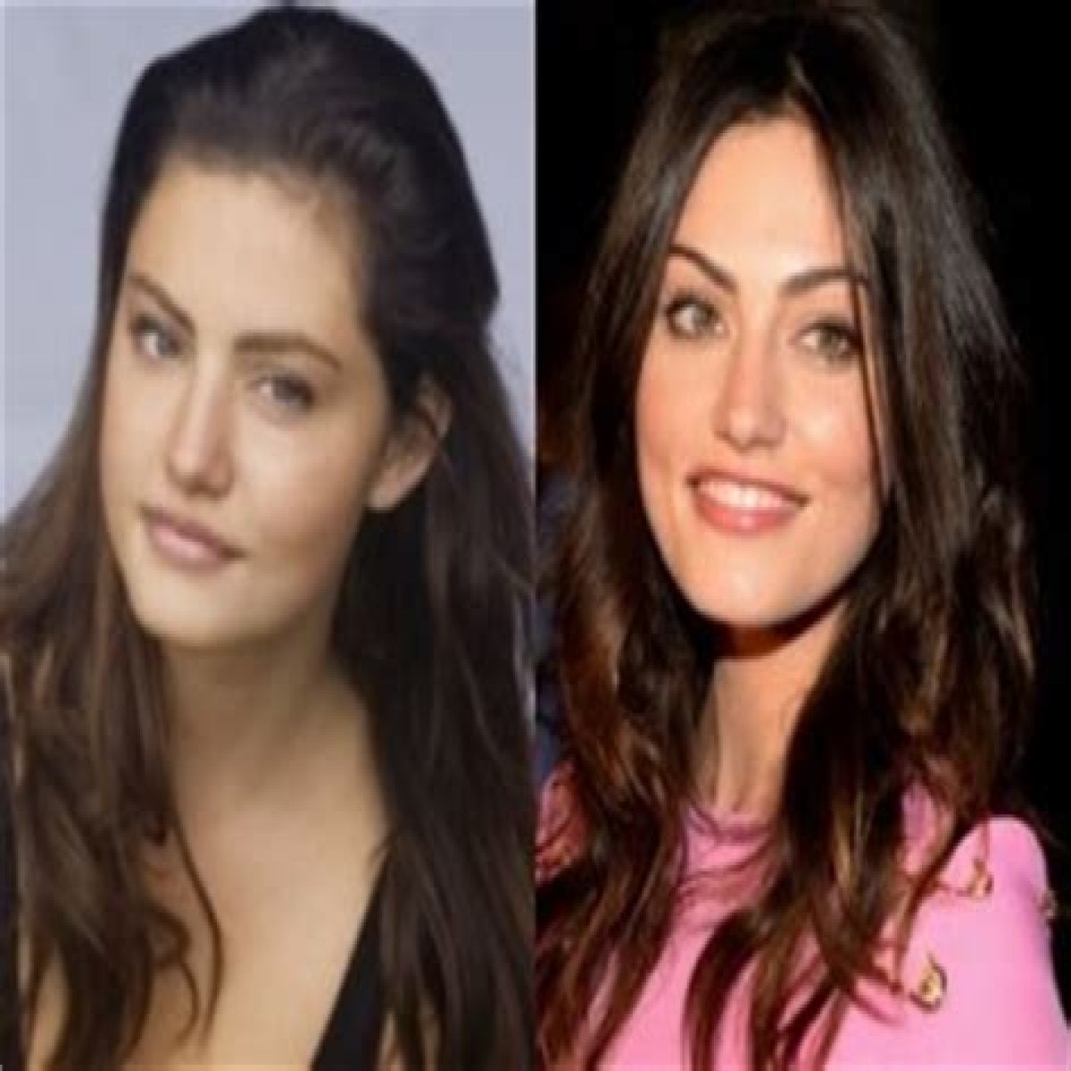 Phoebe Tonkin Plastic Surgery Before and After
