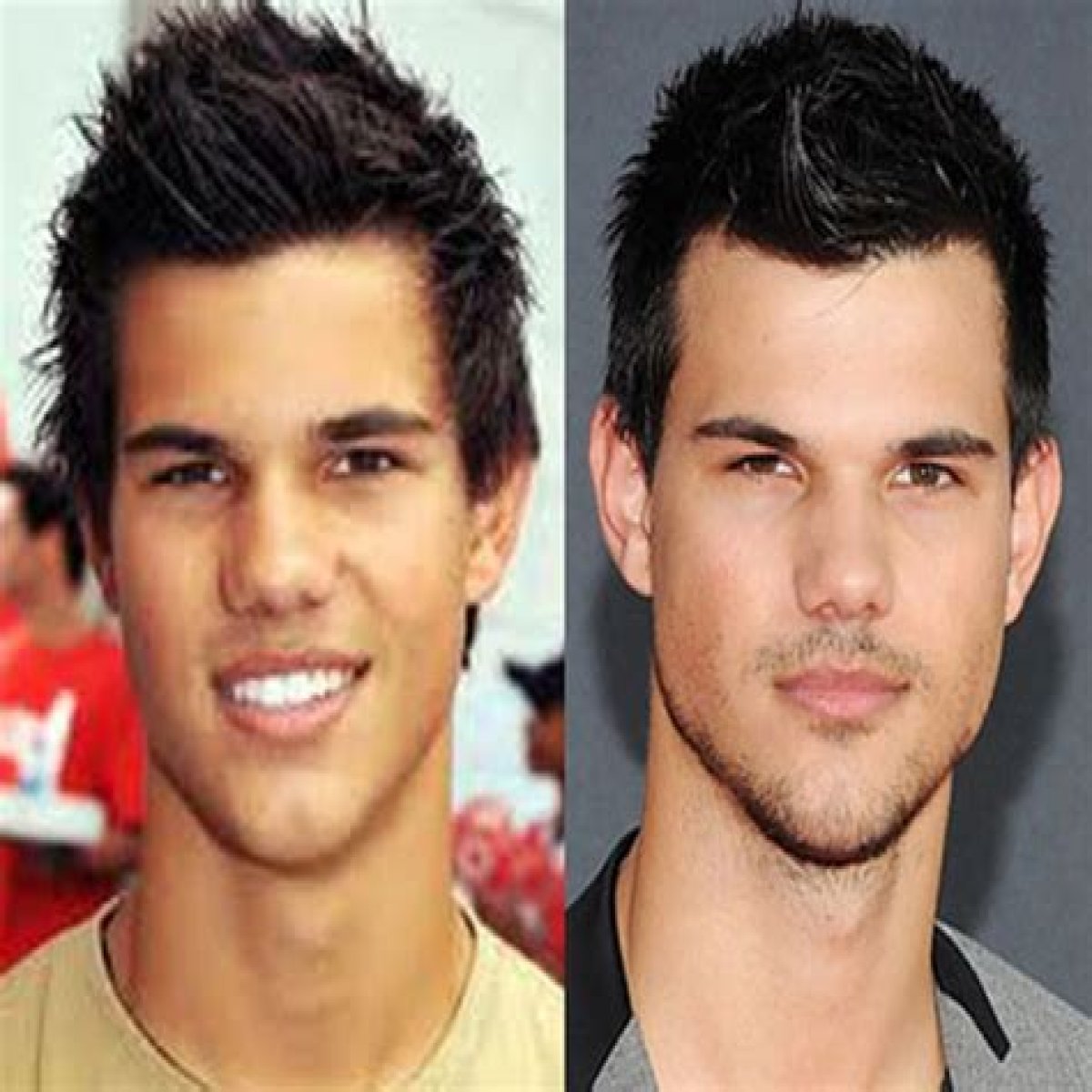Taylor Lautner Plastic Surgery Before and After