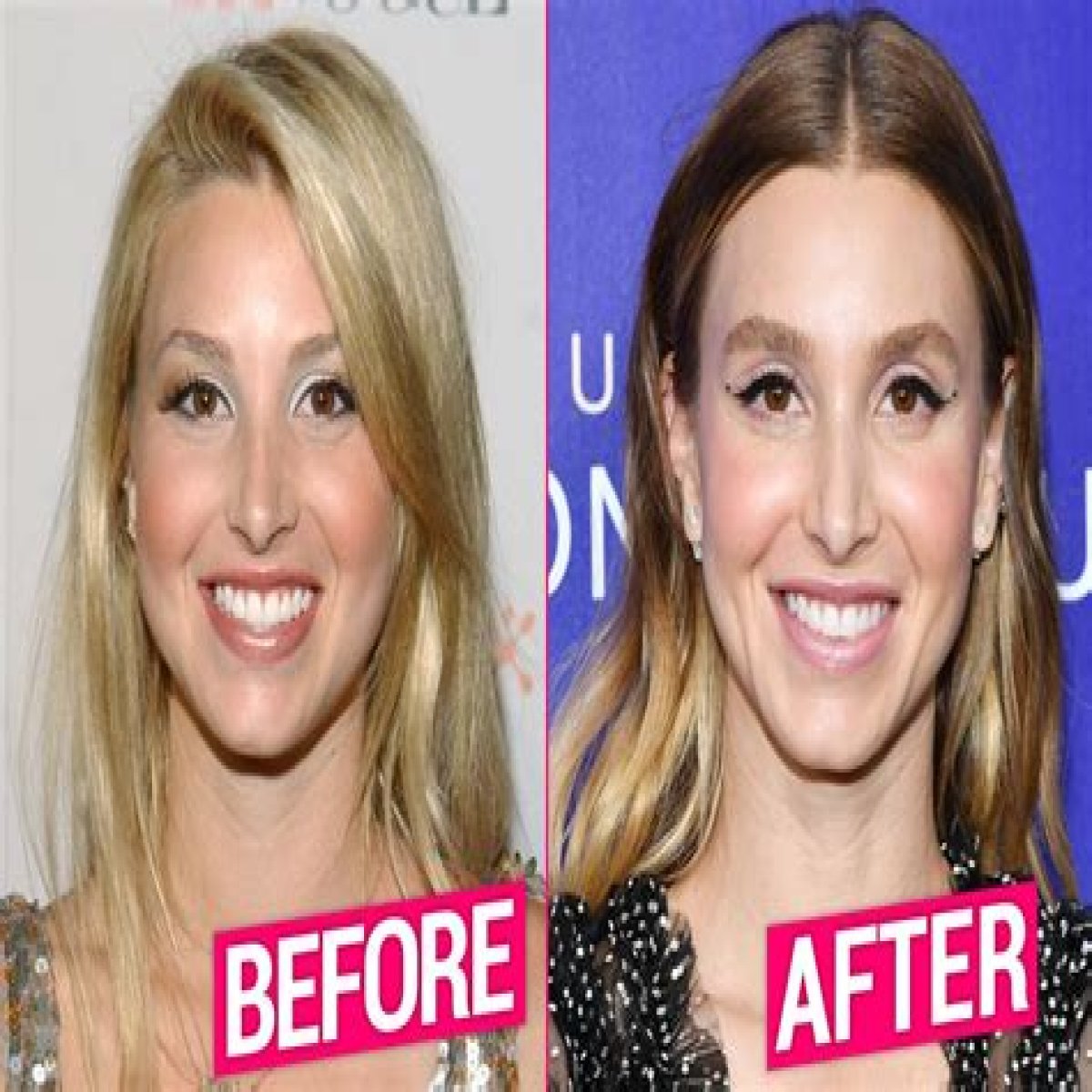 Whitney Port Plastic Surgery Before and After